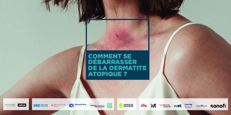 Sujet de la campagne : une image avec une femme souffrant d'eczéma atopique au cou